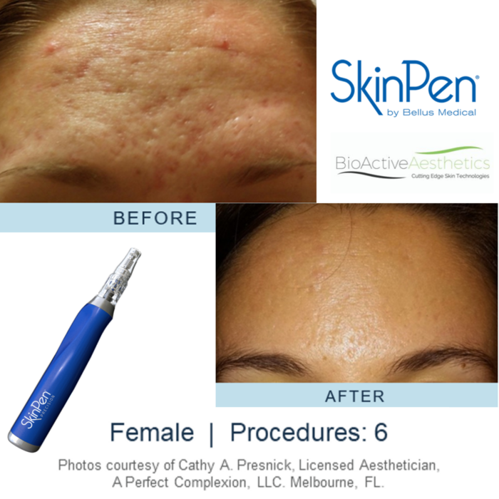Enhance Medispa's new treatment, Skin Pen coming soon!